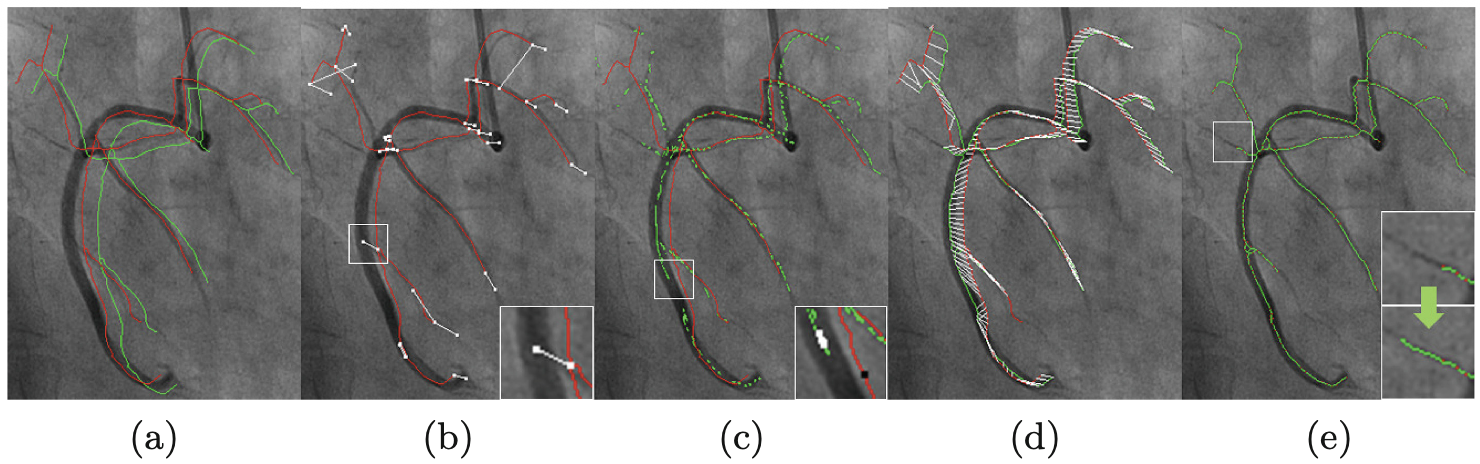 Extraction of coronary vessels in fluoroscopic X-ray sequences using vessel correspondence optimization.