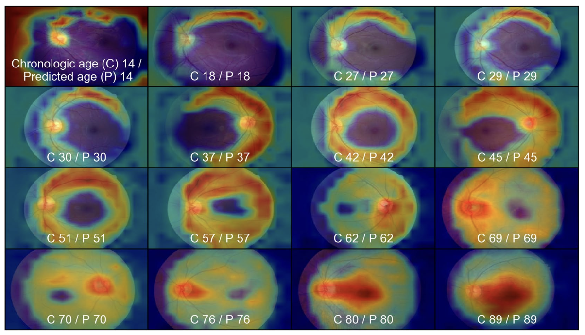 Effects of hypertension, diabetes, and smoking on age and sex prediction from retinal fundus images.