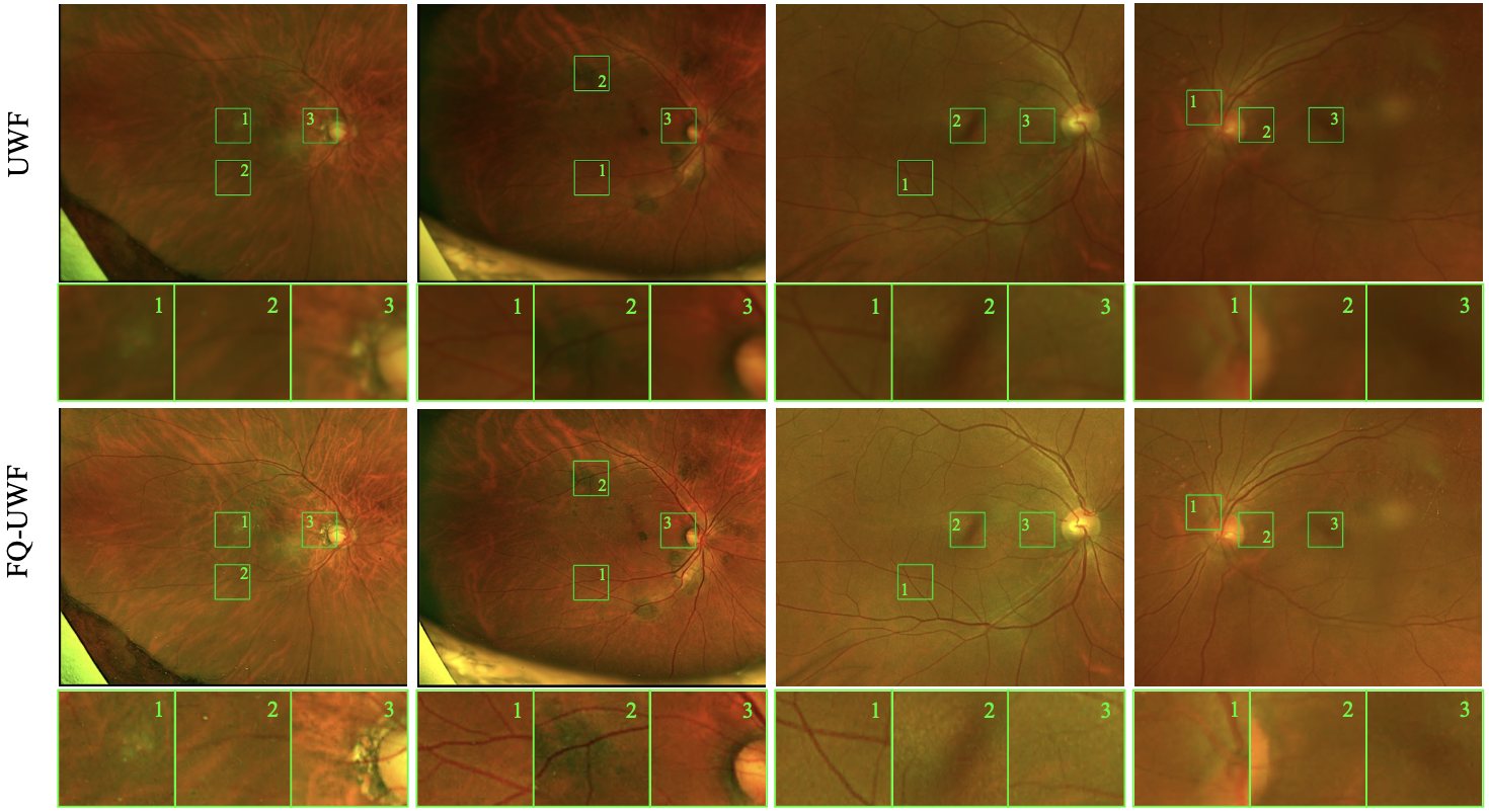 FQ-UWF: unpaired generative image enhancement for fundus quality ultra-widefield retinal images