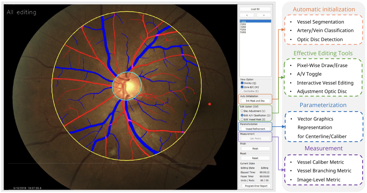 Improving retinal vessel assessment precision by integrating deep learning with interactive editing and graphical modeling